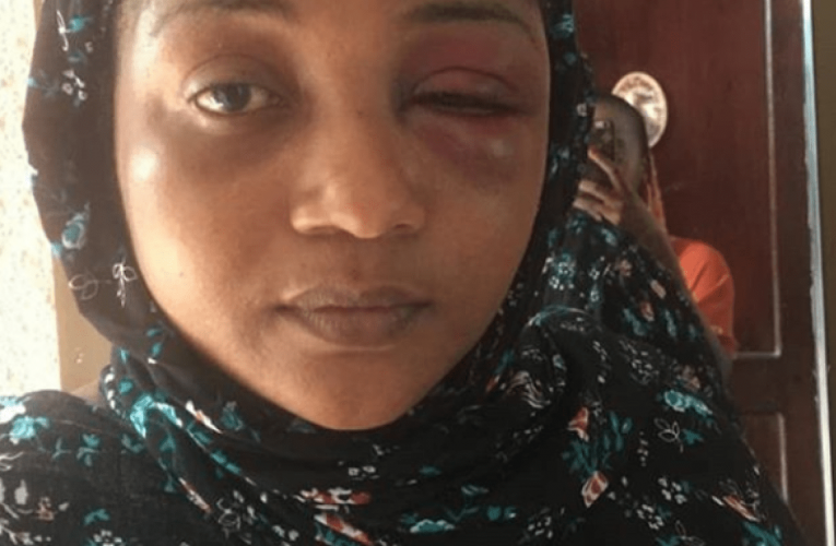 Shock as Tanzanian singer, Shilole, shows battered face at the hands of her hubby