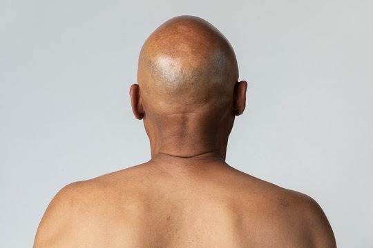 does masturbation cause baldness?