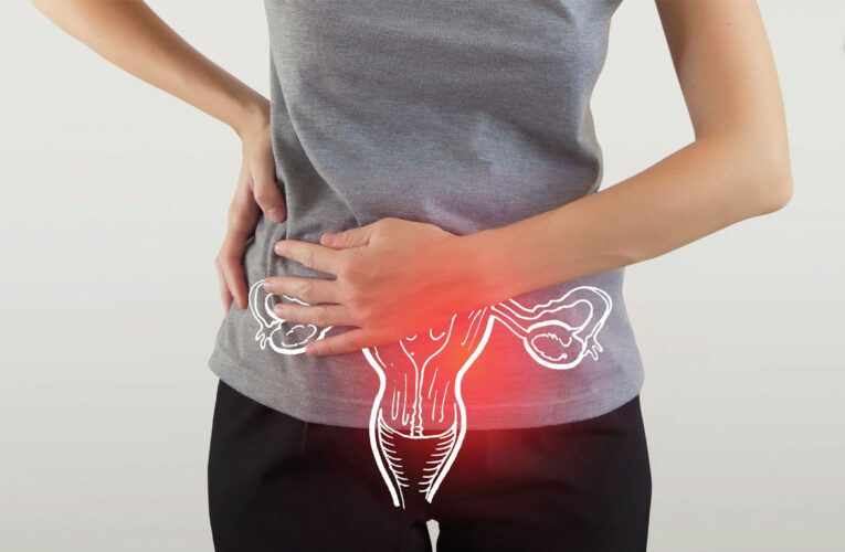 What is PCOS? Symptoms, Effects and Treatment of Polycystic Ovary Syndrome