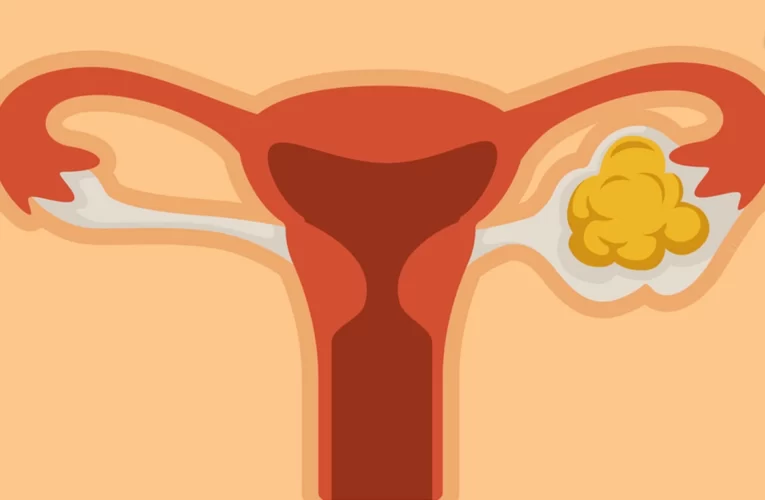 How Does Smoking Affect Women’s Fertility ?