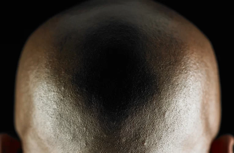 What Is The Link Between Nigerian Bald Men And Cheating?