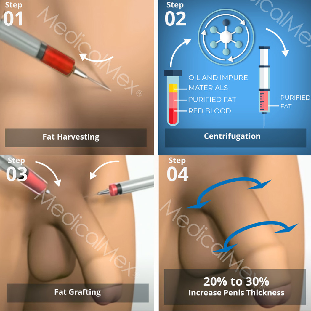 From Inches to Confidence: The Growing Popularity of Penis Enlargement Surgery 2