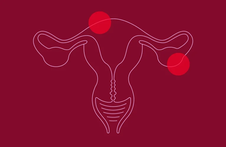 Understanding Endometriosis: Causes, Prevention and Treatment