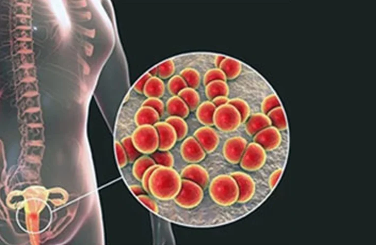 Pelvic Inflammatory Disease:  Diagnosis, Risk Factors and Treatment